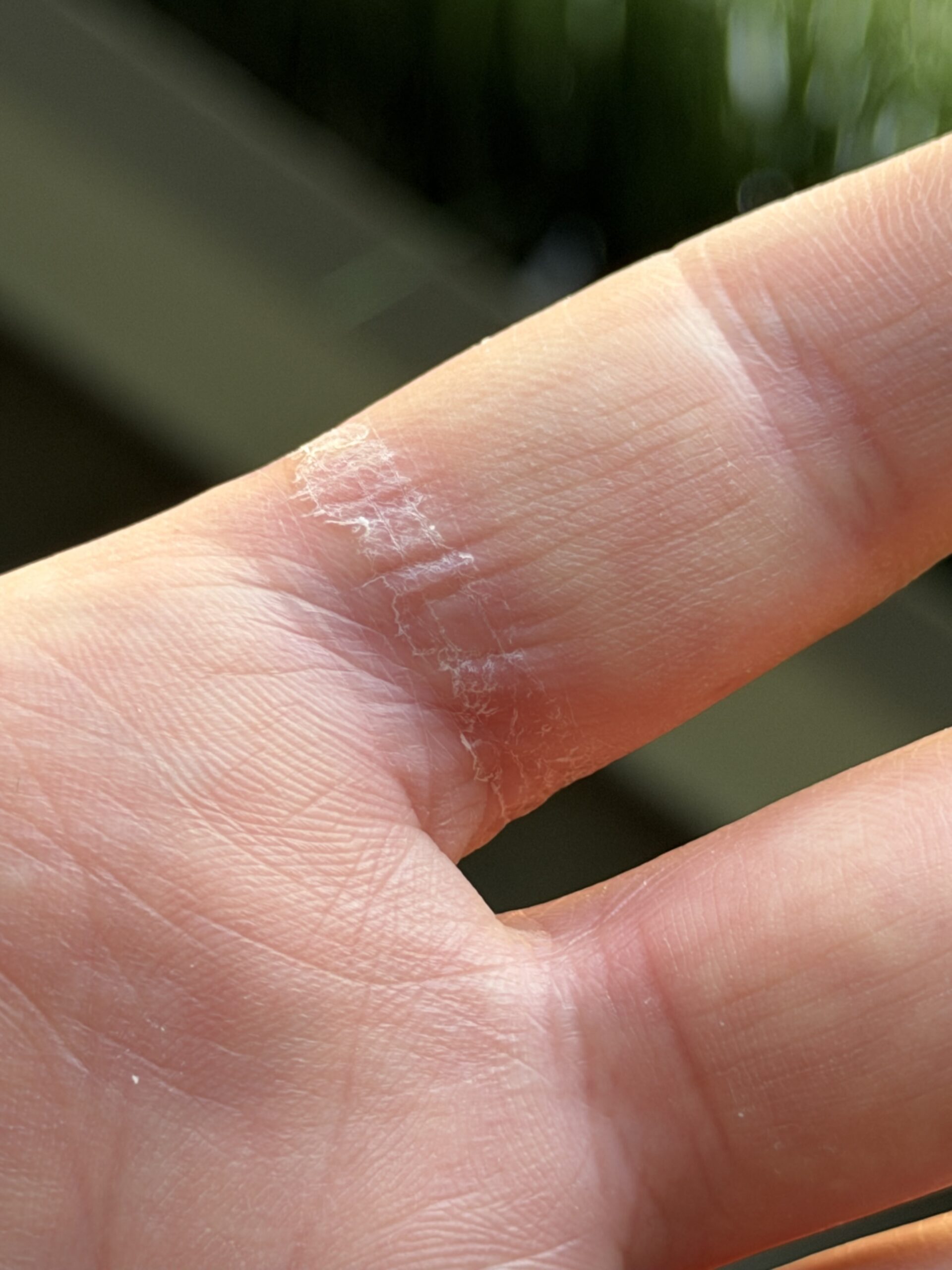 Galaxy Ring swelling Aftermath